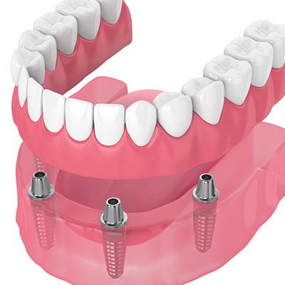 dental implant denture