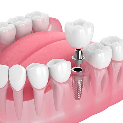 replace tooth with single dental implant and crown