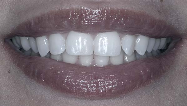 tooth contouring