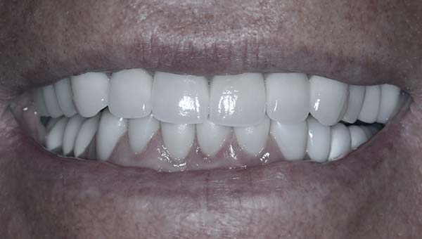 dental implants and crowns